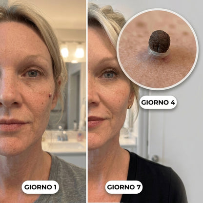 Painless Skin Tag Removal Kit